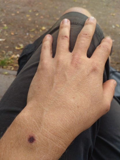 meine hand mit verletzung